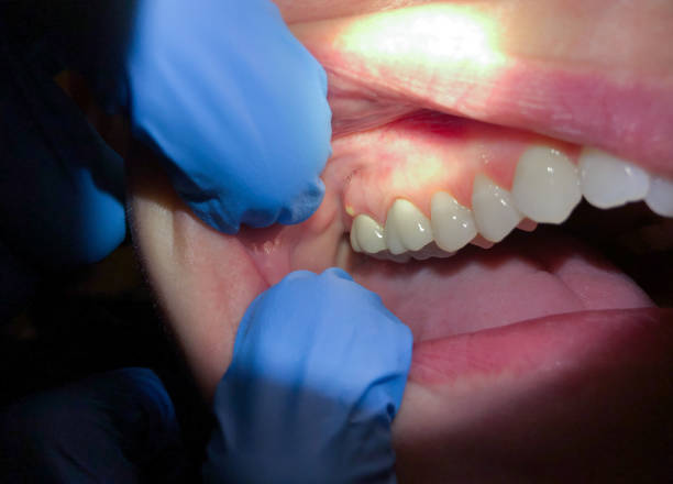 Best Emergency Treatment for Oral Infections in Brewster Hill, NY